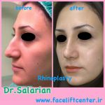 iran rhinoplasty before and after