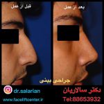 هزینه جراحی بینی در تهران