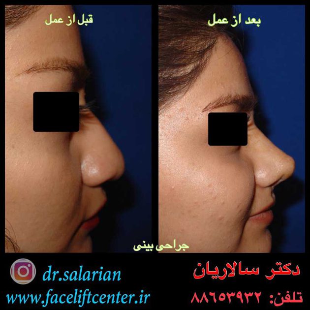 عکس عمل بینی قبل و بعد