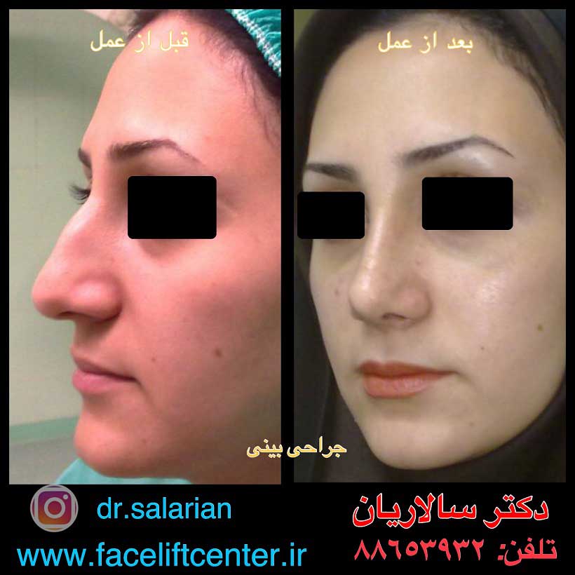 عکس قبل و بعد از عمل بینی