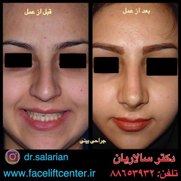 عکس قبل و بعد از عمل بینی